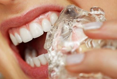 Nguyên nhân vì sao răng bạn dễ bị gãy?